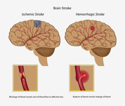 Best Stem Cell Therapy For Stroke | Stroke Doctor